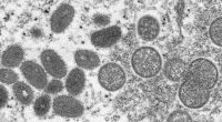 Eine mikroskopische Aufnahme aus dem Jahr 2003 zeigt: So sehen die Affenpocken-Viren aus.
