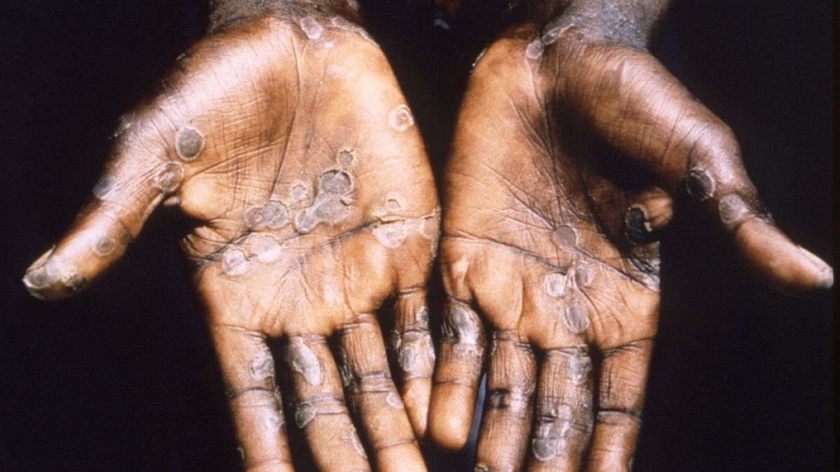 Dieses Bild zeigt die Handflächen eines Affenpockenpatienten aus Lodja, einer Stadt im Katako- Kombe Health Zone, der Demokratischen Republik Kongo. (Foto)