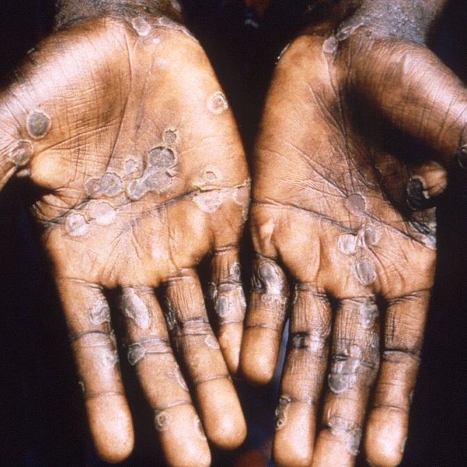 Dieses Bild zeigt die Handflächen eines Affenpockenpatienten aus Lodja, einer Stadt im Katako- Kombe Health Zone, der Demokratischen Republik Kongo.