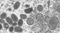So sehen die Affenpocken-Viren unter einem Mikroskop aus.