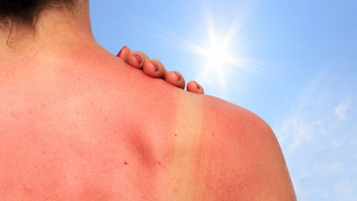 Ein Sonnenbrand schädigt langfristig die Haut. (Symbolfoto) (Foto)
