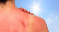 Ein Sonnenbrand schädigt langfristig die Haut. (Symbolfoto)