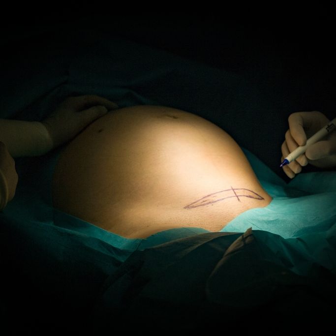 Arzt will Baby 3 Monate zu früh holen - Schwangere kämpft um ihr Leben