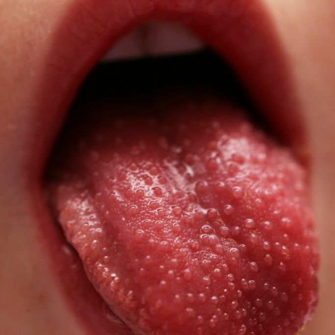 Verfärbte Zunge und Ausschlag! Behörden warnen vor hochansteckender Krankheit