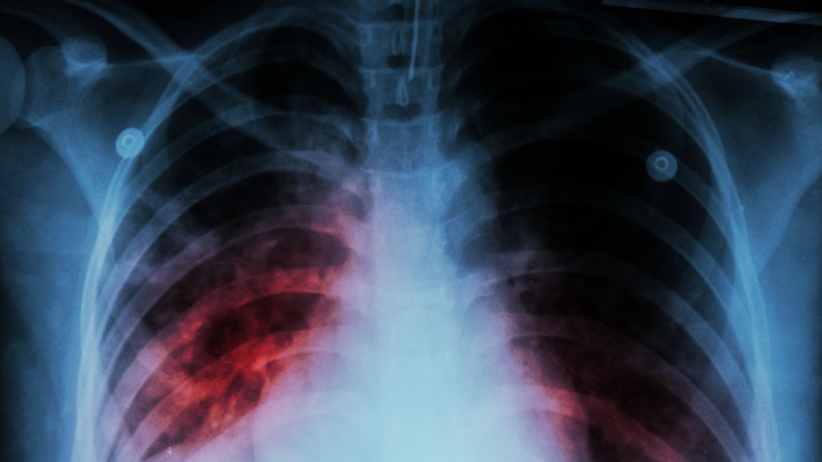 Ein Röntgenbild zeigt, wie sich die Tuberkulose-Infektion in der Lunge eines Erkrankten ausbreitet. (Foto)