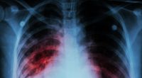 Ein Röntgenbild zeigt, wie sich die Tuberkulose-Infektion in der Lunge eines Erkrankten ausbreitet.