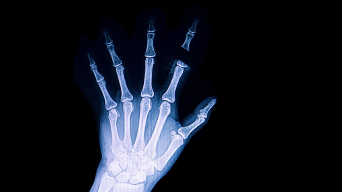 Eine 30-jährige Patientin stellte sich mit hartnäckigem Durchfall im Krankenhaus vor - wenig später wurden der Frau alle Zehen und mehrere Finger amputiert (Symbolfoto). (Foto)