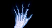 Eine 30-jährige Patientin stellte sich mit hartnäckigem Durchfall im Krankenhaus vor - wenig später wurden der Frau alle Zehen und mehrere Finger amputiert (Symbolfoto).