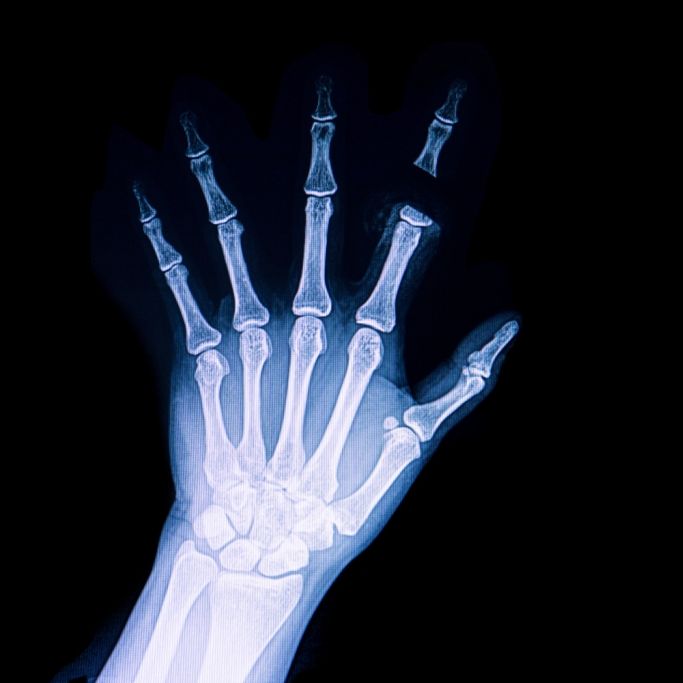 Durchfall-Patientin büßt Finger und Zehen ein - DAS war die wahre Diagnose