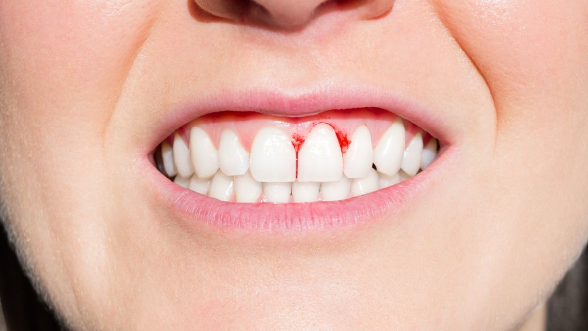 Der Versuch, sich im Drogenrausch schmerzende Zähne aus dem Mund zu reißen, endete für eine 29-Jährige aus England tödlich. (Foto)