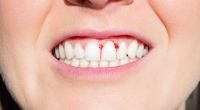 Der Versuch, sich im Drogenrausch schmerzende Zähne aus dem Mund zu reißen, endete für eine 29-Jährige aus England tödlich.