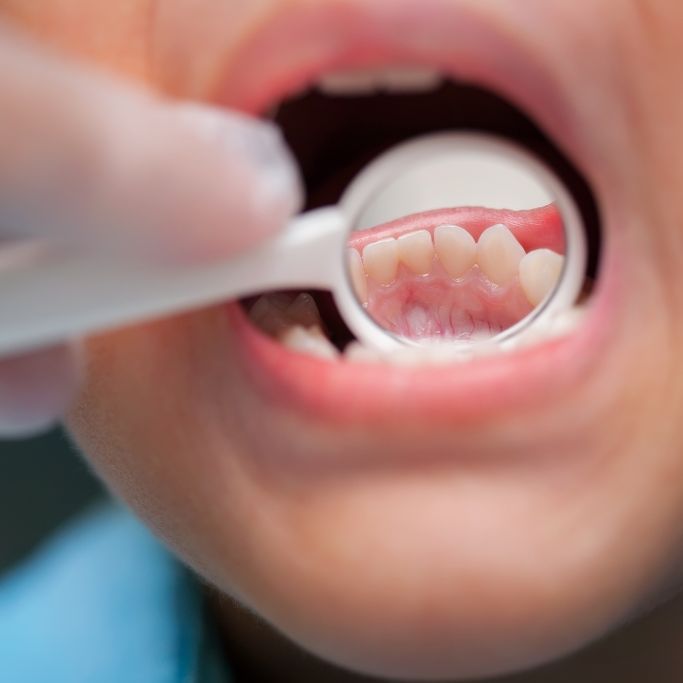 Mädchen (8) erstickt nach Zahnarztbesuch an seinem eigenen Blut