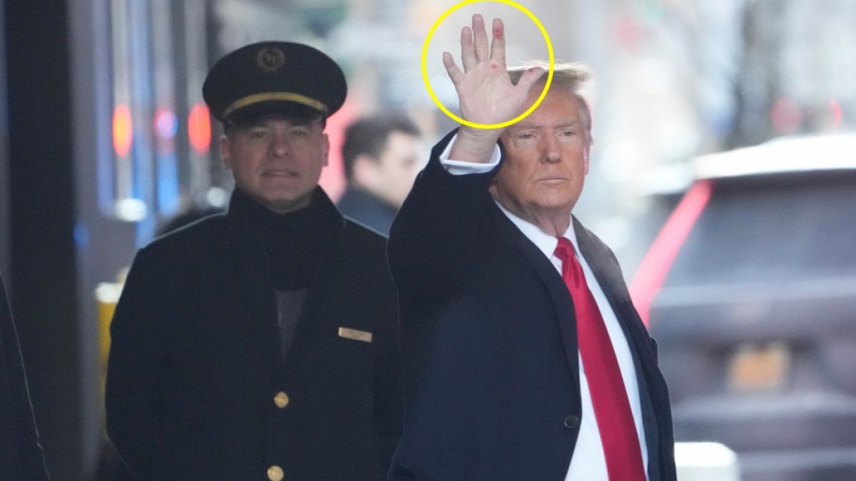 Was sind das für mysteriöse Flecken an der Hand von Donald Trump? (Foto)