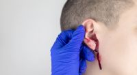 Offenbar im Drogenrausch soll sich ein Mann in Tschechien beide Ohren und den Penis abgeschnitten haben (Symbolfoto).
