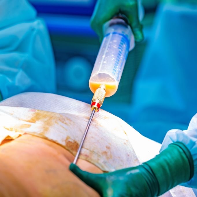 Pfusch-Doktor lockt mit Beauty-OP zum Schleuderpreis - Patientin tot