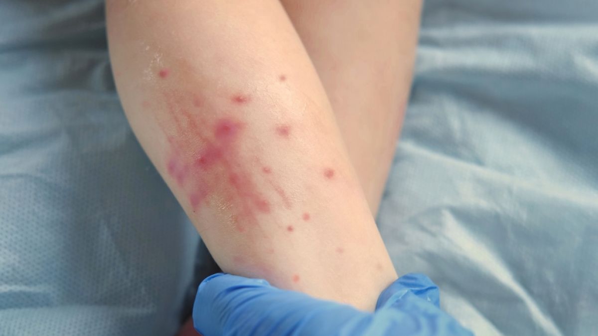 Wissenschaftler warnen vor einer Mpox-Pandemie. (Foto)