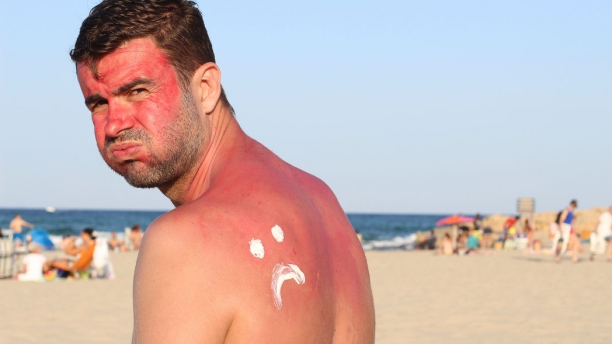 Sonnenbrand erhöht das Krebsrisiko. (Foto)