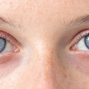Arzt rät: Covid-Infizierte sollten ihre Augen untersuchen lassen