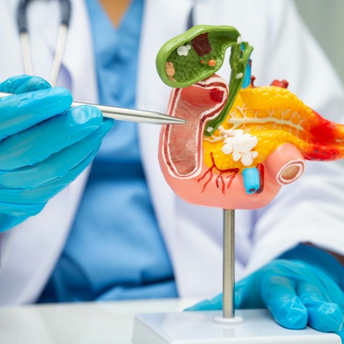 Das müssen Sie über Bauchspeicheldrüsenkrebs wissen