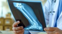 Knochenbrüche treten bei Osteoporose häufiger auf und können im hohen Alter tödlich enden.
