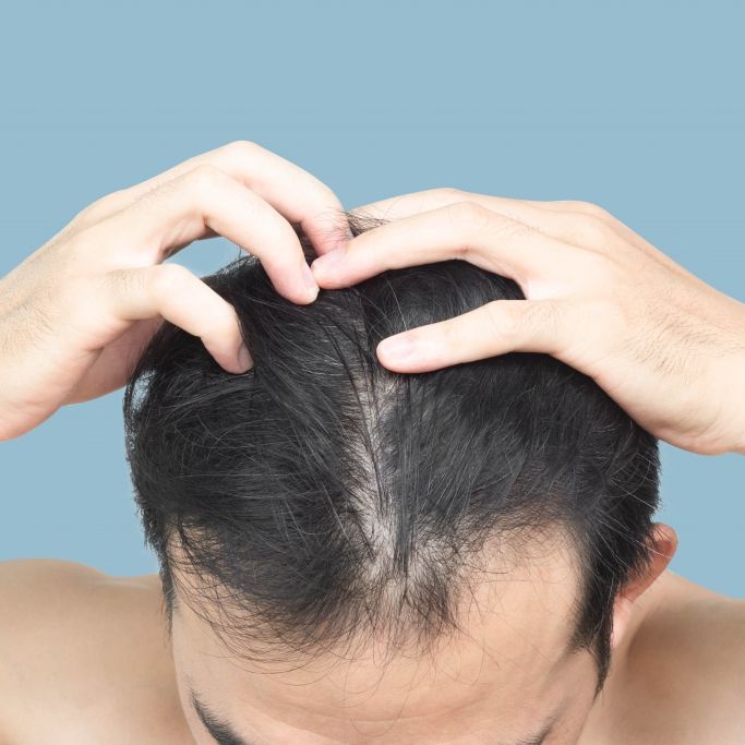 Beliebte Softdrinks führen bei Männern zu Haarverlust