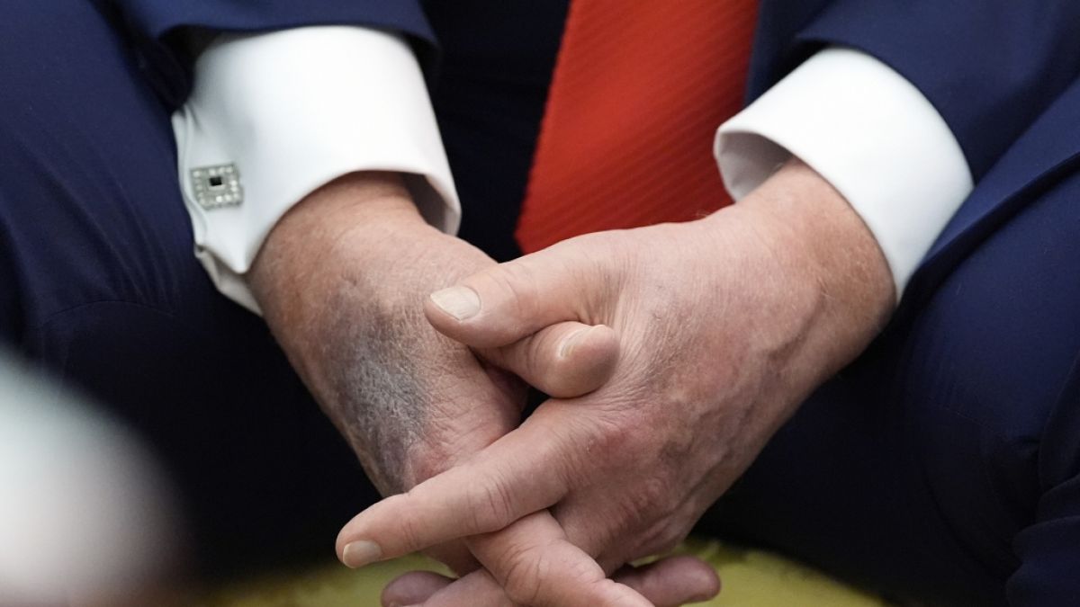 Donald Trump hat seit Monaten Blutergüsse an seinen Händen. (Foto)