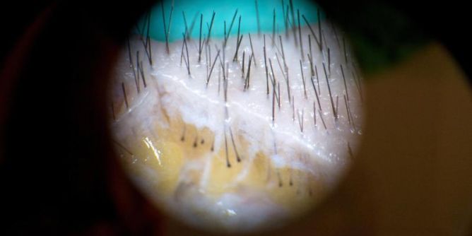 Das 2.000-Euro-Versprechen Haartransplantation in der Türkei