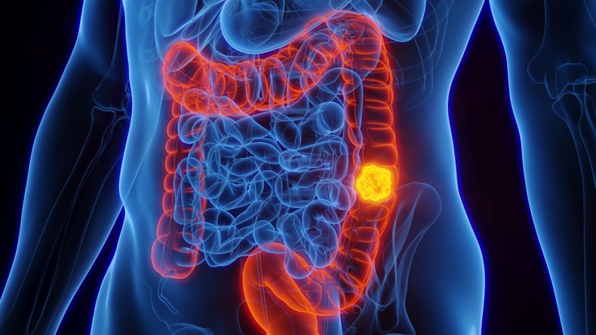 Millennials erkranken h&auml;ufiger an Darm-, Brust- und Schilddr&uuml;senkrebs als ihre Eltern. (Foto)