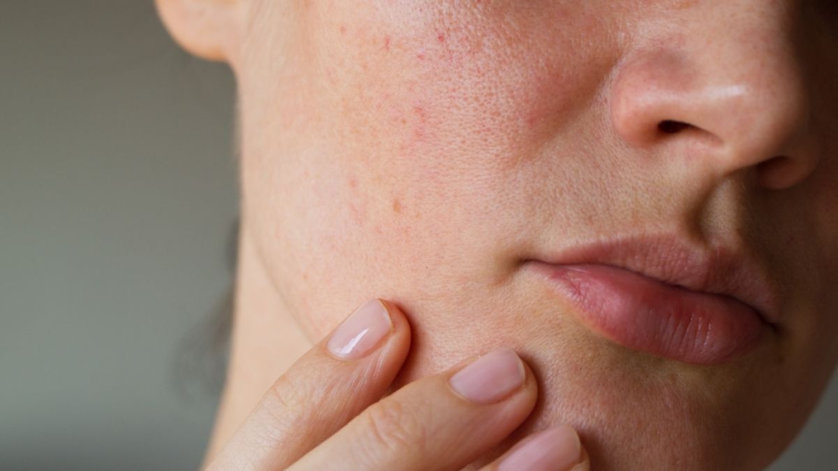 Hautunreinheiten im Gesicht k&ouml;nnen Aufschluss &uuml;ber den Gesundheitszustand geben. (Foto)