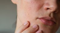 Hautunreinheiten im Gesicht können Aufschluss über den Gesundheitszustand geben.