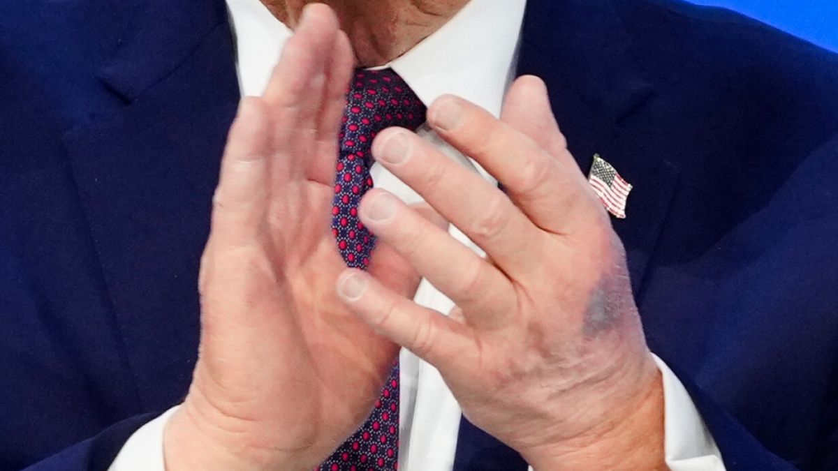 Ein blauer Fleck an Trumps Hand l&ouml;ste erneut Spekulationen &uuml;ber seinen Gesundheitszustand aus. (Foto)