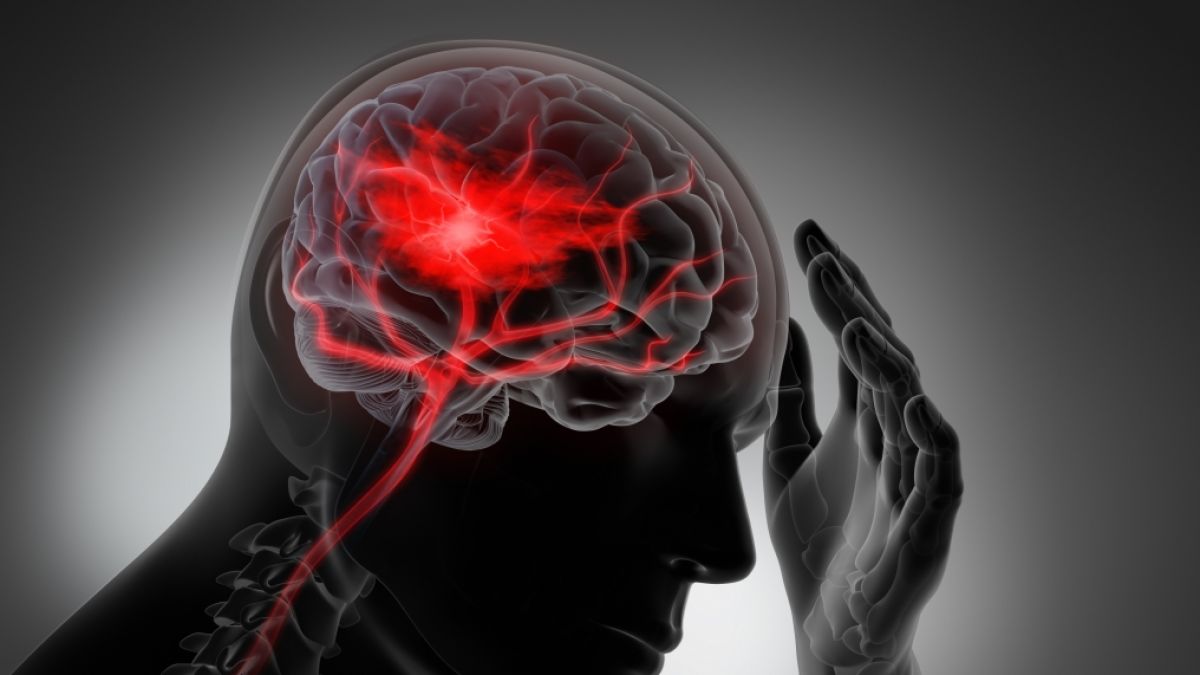 Bestimmte Warnzeichen k&ouml;nnen auf einen Schlaganfall hinweisen (Symbolfoto). (Foto)