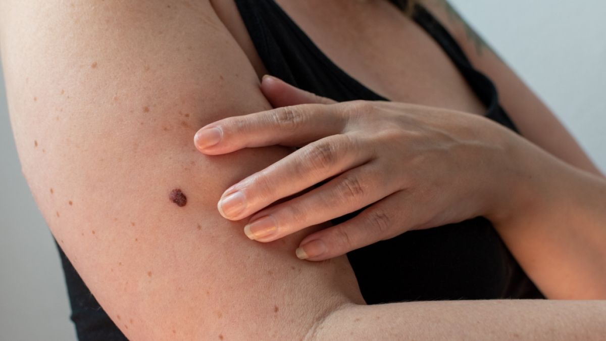 Oberfl&auml;chliche Ver&auml;nderungen an Leberflecken k&ouml;nnen mitunter auf Hautkrebs hinweisen. (Foto)