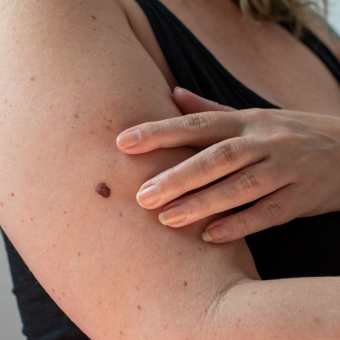 Auf diese Krebs-Anzeichen sollten Sie sich regelmäßig abchecken