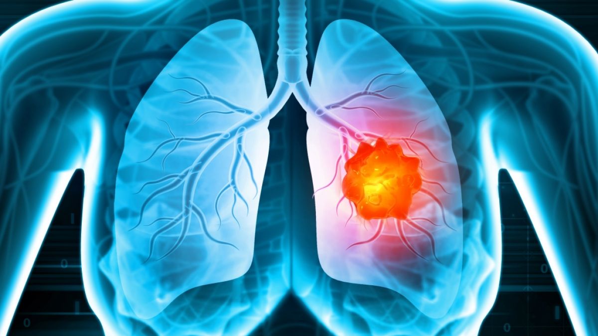 Nach einem schweren Verlauf von Covid-19 kann sich das Risiko f&uuml;r Lungenkrebs erh&ouml;hen. (Foto)