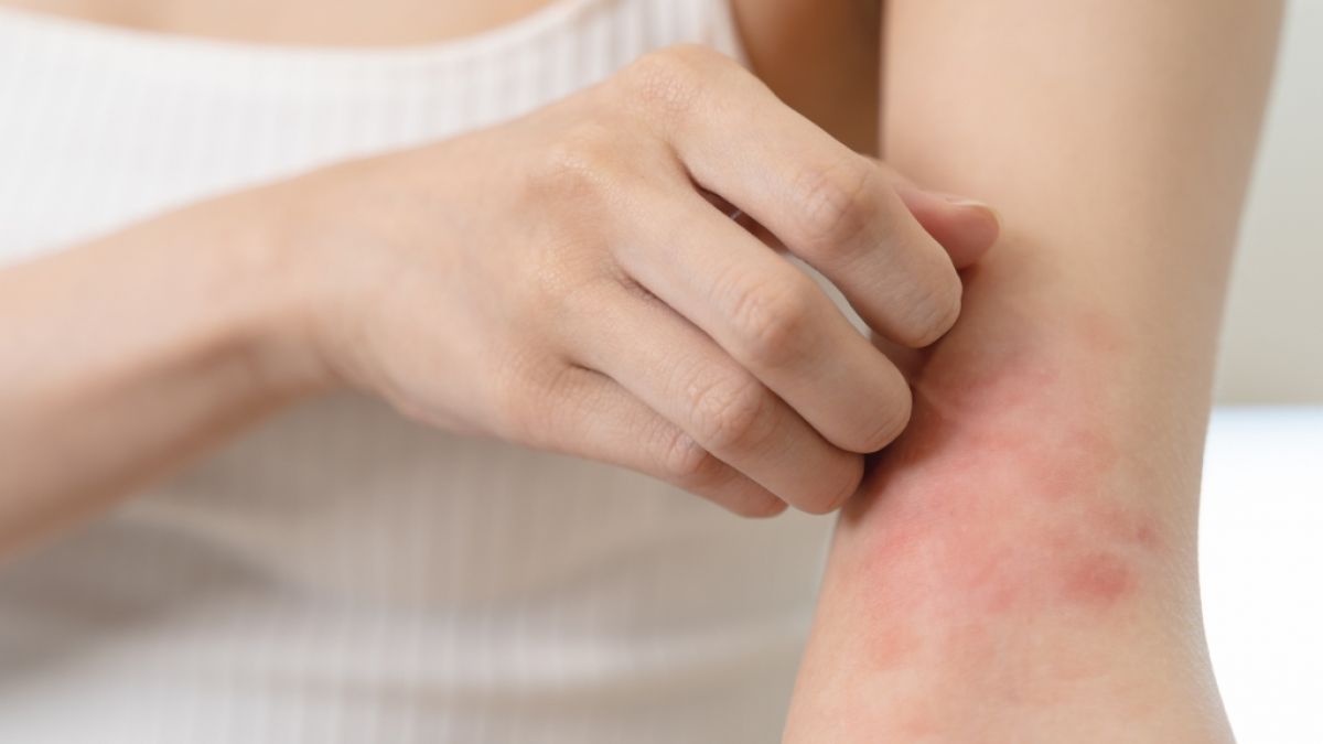 R&ouml;tungen und juckende Stellen k&ouml;nnen mitunter auf Diabetes hinweisen. (Foto)