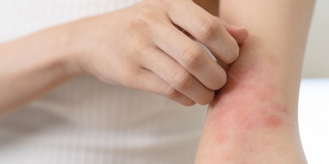 Juckreiz und Rötungen