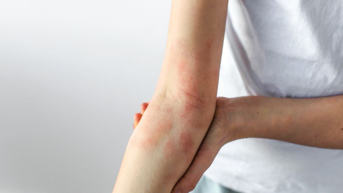 Wer unter dauerhaft ger&ouml;teter und gereizter Haut leidet, sollte sich m&ouml;glicherweise auf Diabetes untersuchen lassen. (Foto)