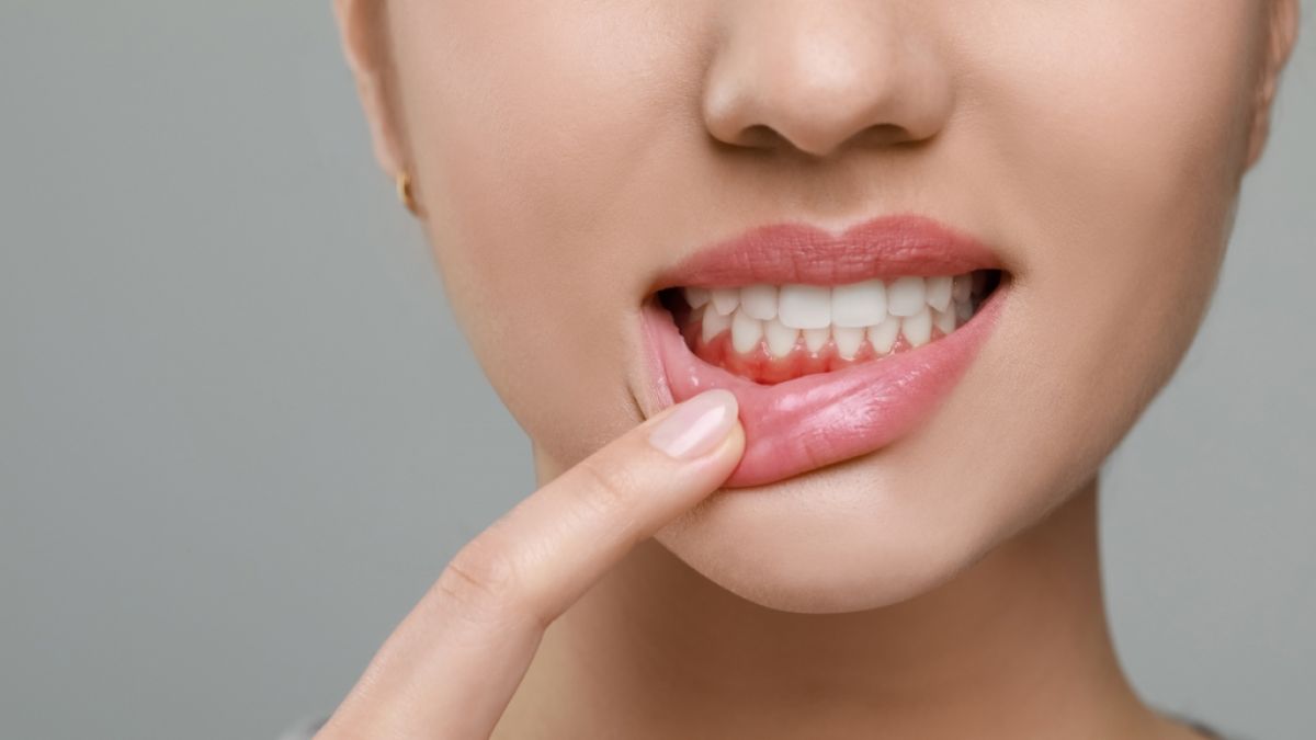 Zahnfleischentz&uuml;ndungen oder Karies k&ouml;nnen auf Diabetes hinweisen. (Foto)