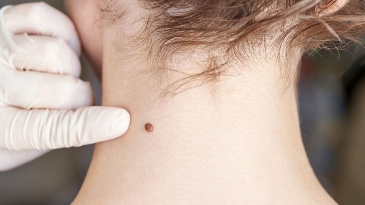 Dermatologen warnen: Ein Ausbleiben regelm&auml;&szlig;iger Screenings k&ouml;nnte zu unbemerktem Tumorwachstum f&uuml;hren. (Foto)