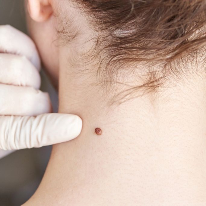 Wie gut schützt das kostenlose Hautkrebs-Screening wirklich?