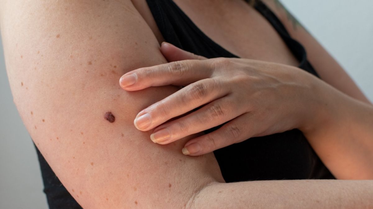 Die Hautkrebs-Vorsorge soll bald gestrichen werden - die Ma&szlig;nahme sei bislang nicht erfolgreich genug gewesen, so die Begr&uuml;ndung des Gesundheitsministeriums. (Foto)