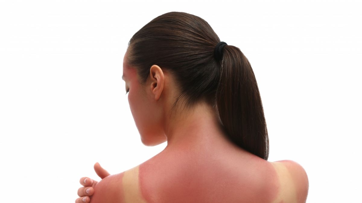Erste Hilfe bei Sonnenbrand: Nicht jede Creme hilft (Symbolfoto). (Foto)