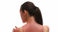 Erste Hilfe bei Sonnenbrand: Nicht jede Creme hilft (Symbolfoto).