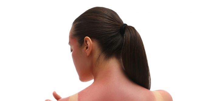 Hilfe bei Sonnenbrand