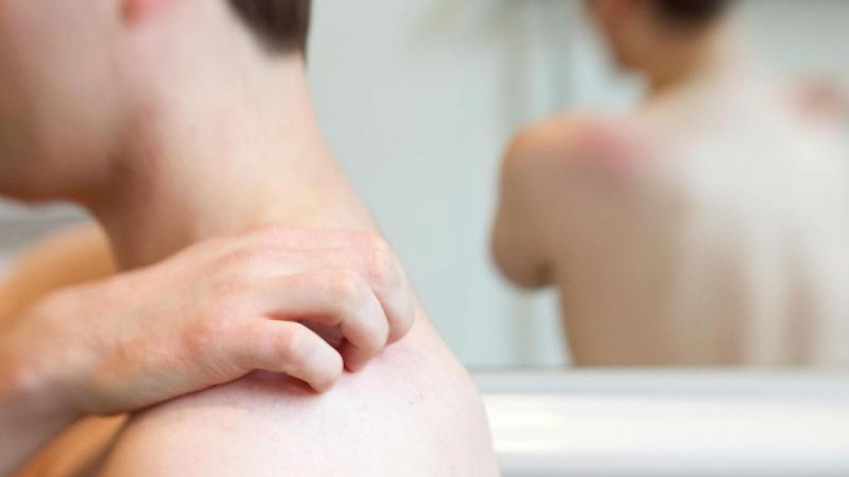 Die R&ouml;schenflechte kann teils heftigen Juckreiz verursachen. Zum Gl&uuml;ck tritt sie bei den meisten Betroffenen aber nur einmal im Leben auf. Foto: Friso Gentsch/dpa/dpa-tmn (Foto)