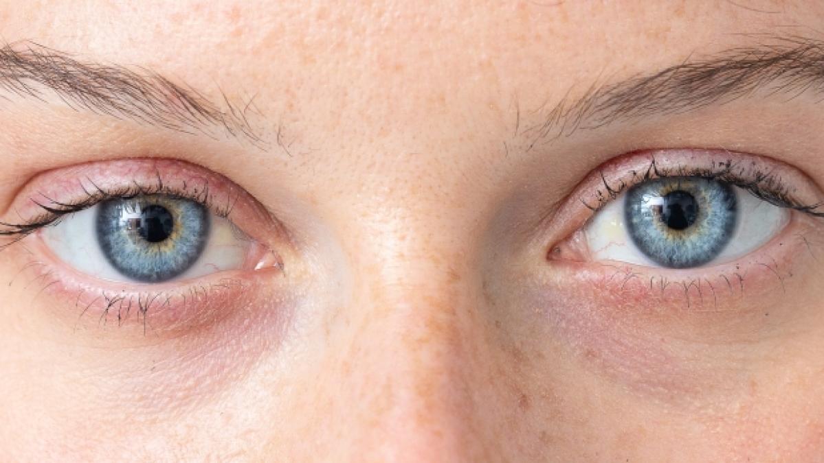 Eine Infektion mit den neuartigen Coronaviren kann den Augen schaden (Symbolfoto). (Foto)
