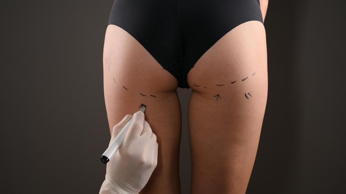 Das argentinische Model Silvina Luna (43) ist an den Folgen eines verpfuschten "Brazilian Butt Lift" gestorben. (Symbolfoto) (Foto)