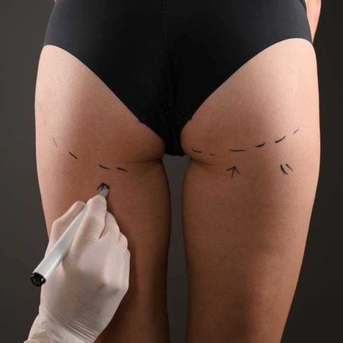 Nierenversagen! Model (43) nach verpfuschtem Po-Lifting gestorben