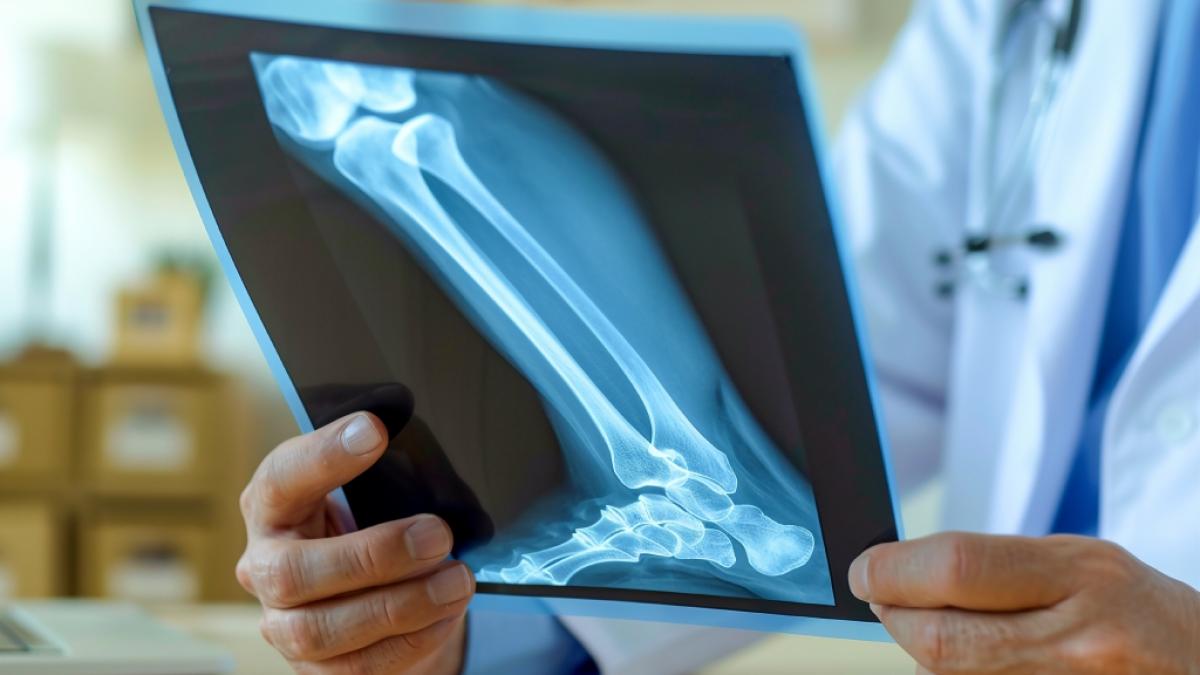 Knochenbr&uuml;che treten bei Osteoporose h&auml;ufiger auf und k&ouml;nnen im hohen Alter t&ouml;dlich enden. (Foto)